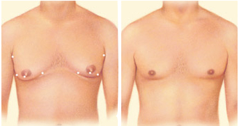 Липосакция груди у мужчин (Гинекомастия)