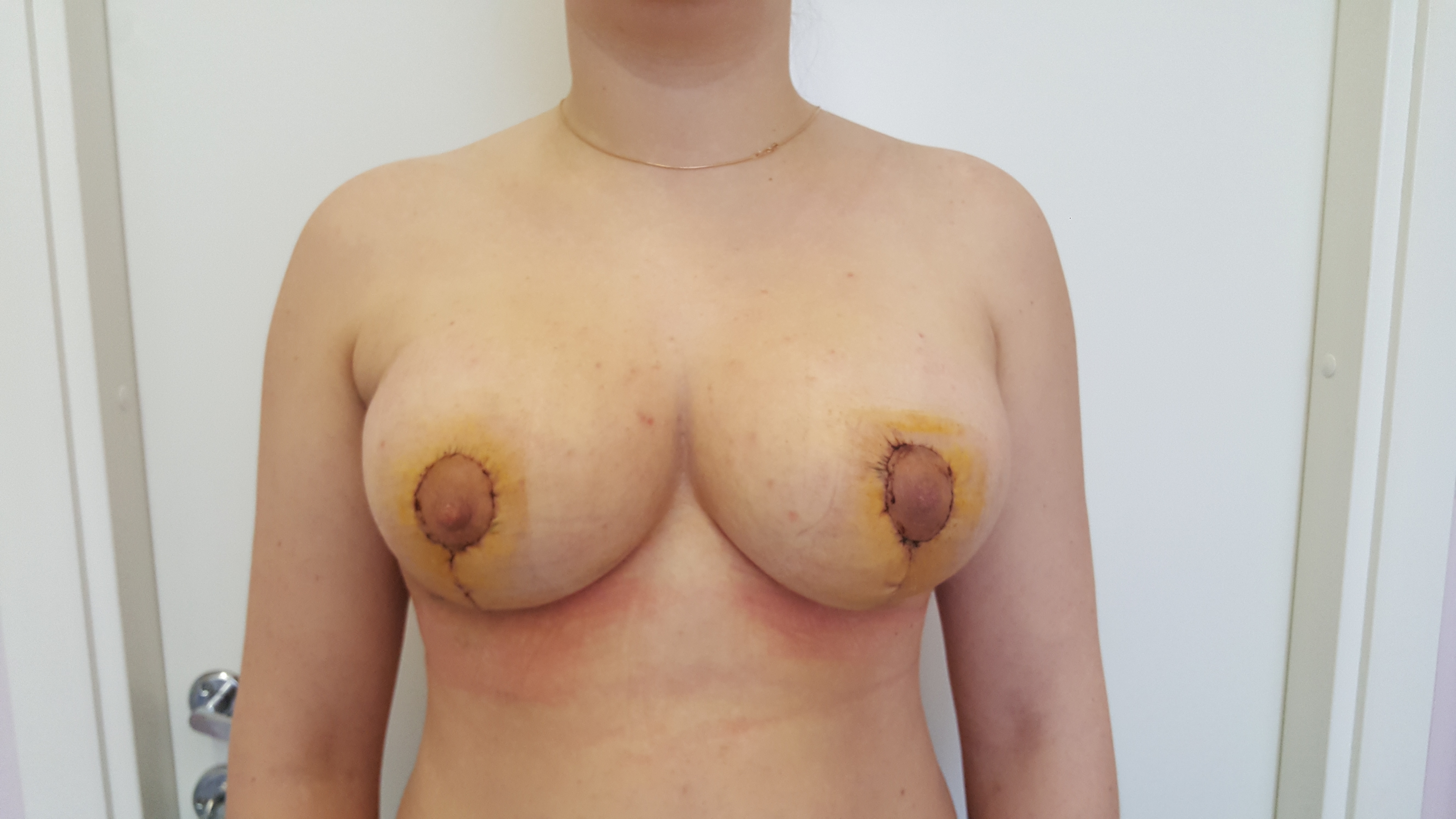 форум женщин с кистой груди фото 66