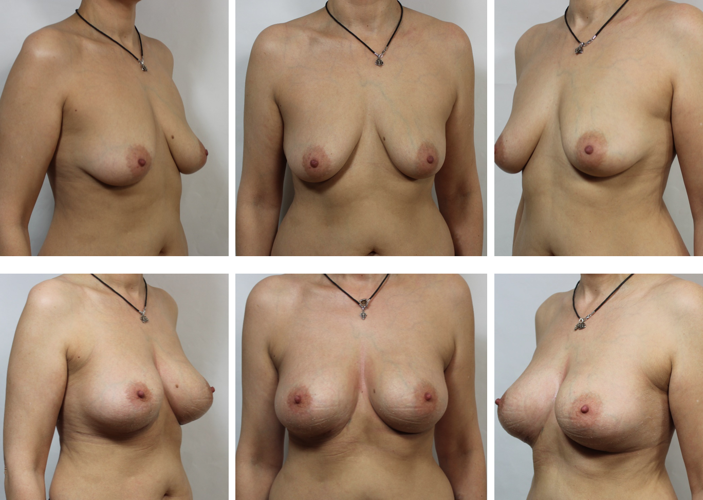 груди разного размера операция фото 68