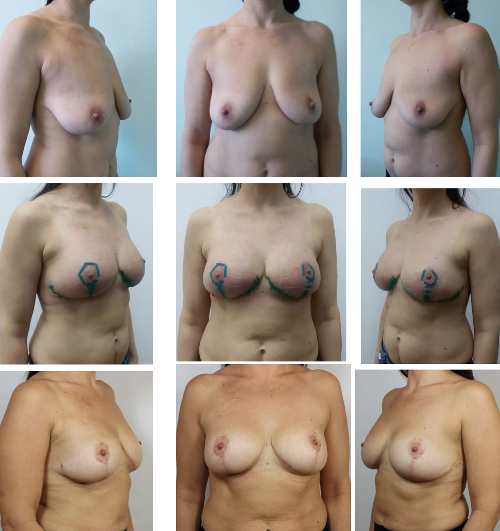разновидности форм груди женщин фото 73