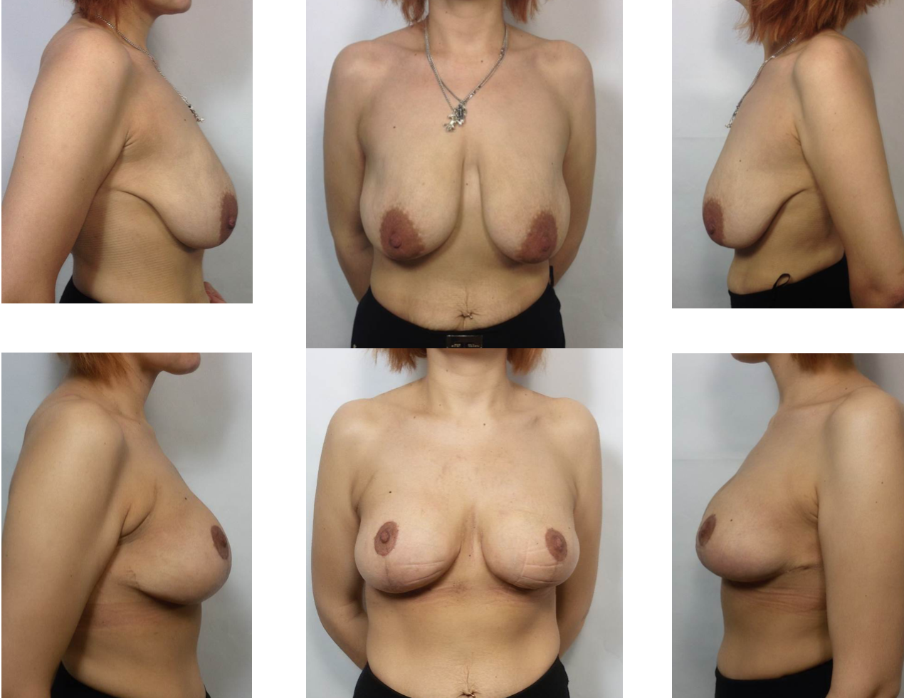 виды форм груди женщин фото 99